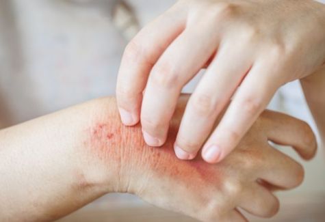 Alergia ao suor, o que fazer? 