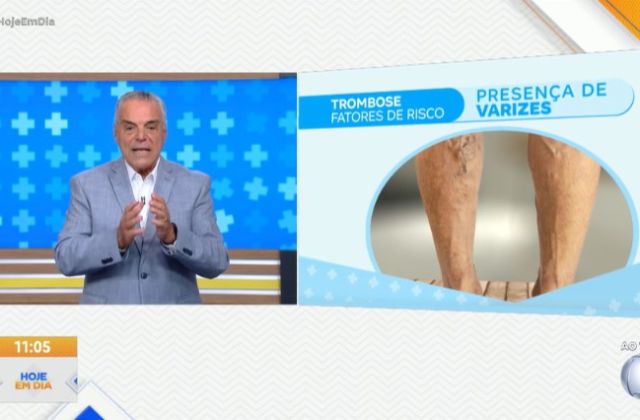 Varizes e outras doenças venosas