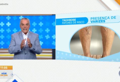 Varizes e outras doenças venosas